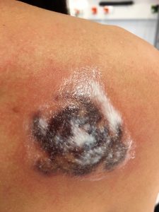 Viimeisen, neljännen käsittelyn jälkeen. Tatuointi rasvattiin Bebanthenilla ja peitettiin sideharsolla.